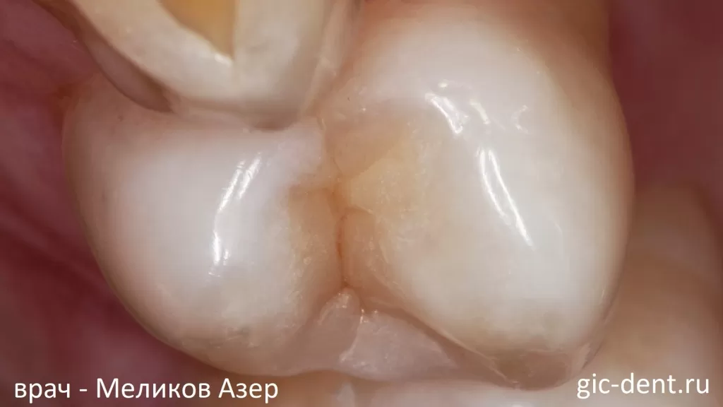 Реставрация зуба премоляра проведена успешно. Автор работы - стоматолог Меликов Азер Фуадович, Немецкий Имплантологический Центр